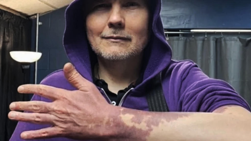 adn24 billy corgan celebra la sua unicità mostrando il nevo vinoso